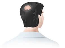 Alopecia areata (zonala)