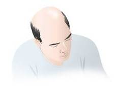 Alopecia androgen-genetica